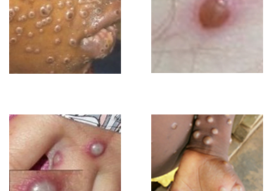 Four images of how monkeypox can appear on the human body